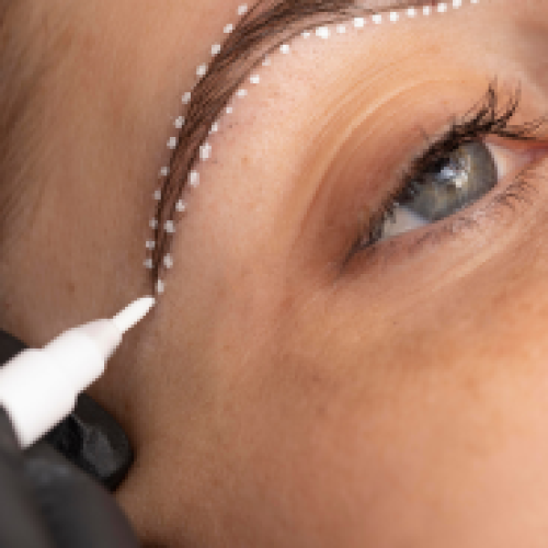 In Which Situations Is Eyebrow Transplantation Performed?